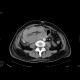 Lymphoma of small bowel: CT - Computed tomography